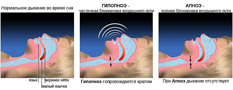 Схема нормального дыхания и при гипопноэ